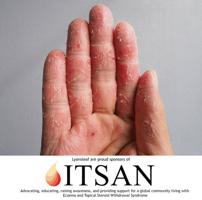 Hand with dry, cracked skin on a gray background, featuring the logo and name of ITSAN.